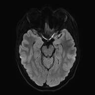 Cerebral cavernous venous malformation (Radiopaedia 70008-80021 Axial DWI 42).jpg