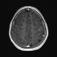 Cerebral cavernous venous malformation (Radiopaedia 70008-80021 Axial T1 C+ 73).jpg