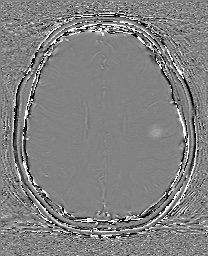 Cerebral cavernous venous malformation (Radiopaedia 70008-80021 G 49).jpg