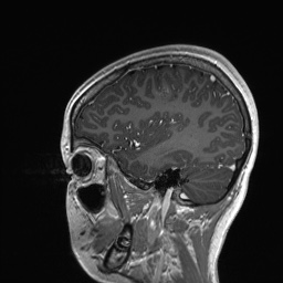 File:Cerebral cavernous venous malformation (Radiopaedia 70008-80021 Sagittal T1 C+ 18).jpg