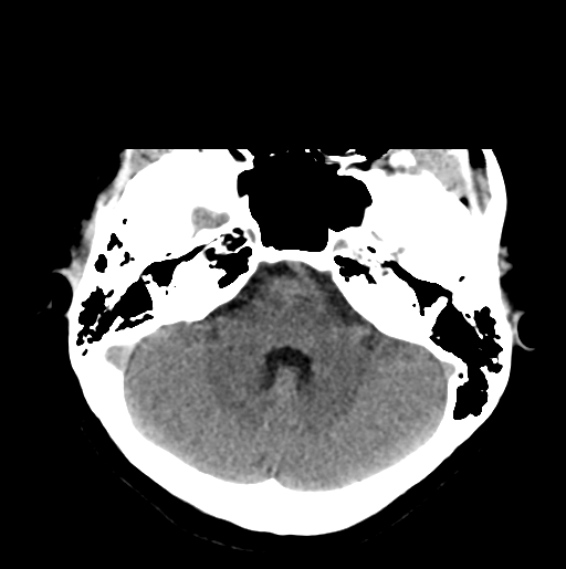 File:Cerebral cavernous venous malformations (Radiopaedia 48117-52945 Axial non-contrast 9).png