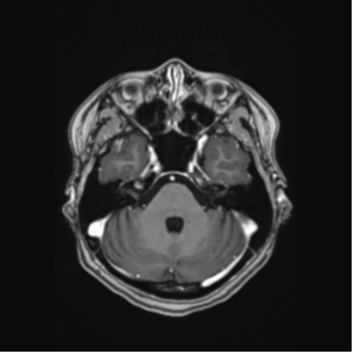Cerebral cavernous venous malformations (Radiopaedia 48117-52946 Axial T1 C+ 12).png