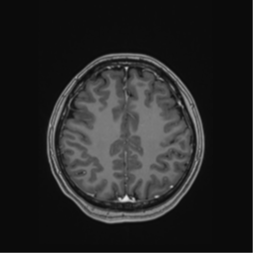 Cerebral cavernous venous malformations (Radiopaedia 48117-52946 Axial T1 C+ 45).png