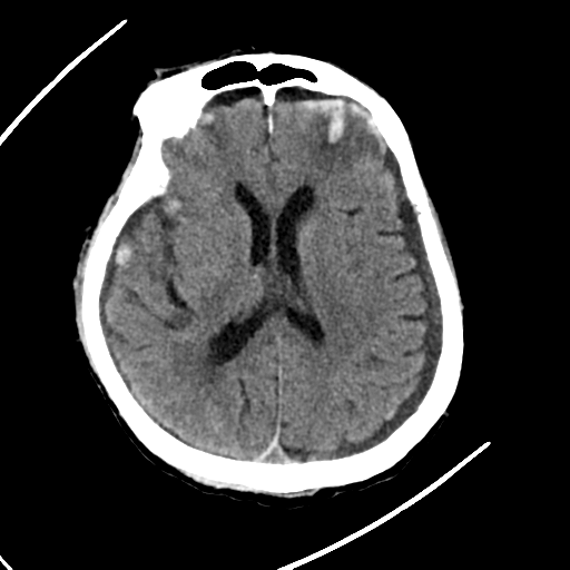 File:Cerebral contusions, subarachnoid hemorrhage and subdural hygromas (Radiopaedia 55399-61830 Axial non-contrast 18).png