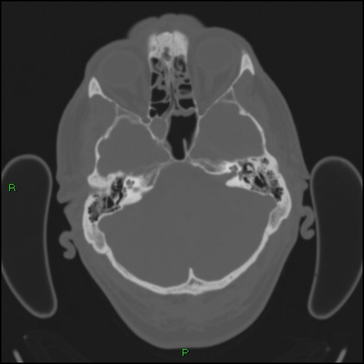 Cerebral contusions (Radiopaedia 33868-35039 Axial bone window 44).jpg