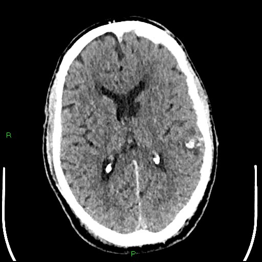 Cerebral contusions (Radiopaedia 33868-35039 Axial non-contrast 116).jpg