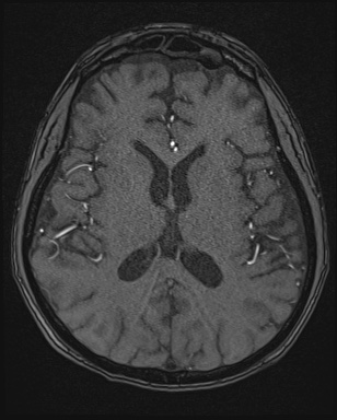Cerebral embolic infarcts (embolic shower) (Radiopaedia 72391-82921 Axial MRA 107).jpg