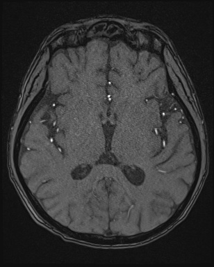 Cerebral embolic infarcts (embolic shower) (Radiopaedia 72391-82921 Axial MRA 96).jpg