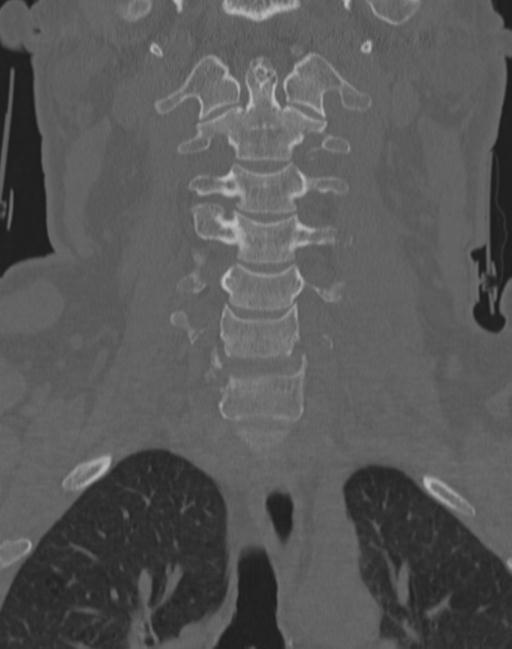 Cerebral hemorrhagic contusions and cervical spine fractures (Radiopaedia 32865-33841 Coronal bone window 28).jpg