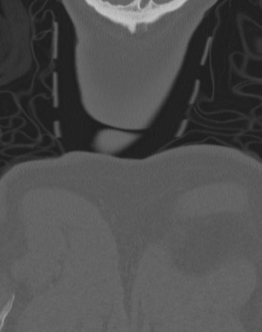 Cerebral hemorrhagic contusions and cervical spine fractures (Radiopaedia 32865-33841 Coronal bone window 89).jpg