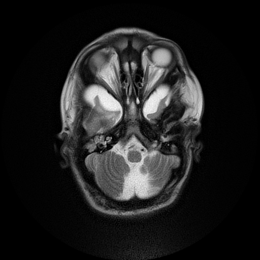 File:Cerebral manifestations of mucopolysaccharidosis type I (Radiopaedia 59171-66487 Axial T2 4).jpg