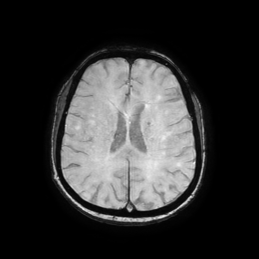 Cerebral metastases - melanoma (Radiopaedia 80972-94522 Axial SWI 63).jpg