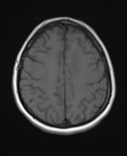 File:Cerebral metastases mimicking abscesses (Radiopaedia 45841-50131 Axial T1 21).png