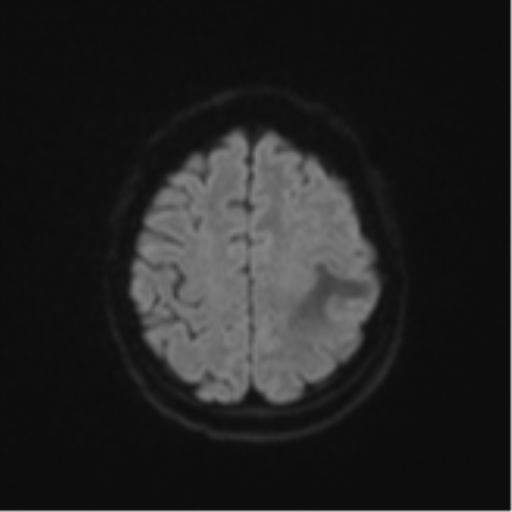 Cerebral metastasis (Radiopaedia 46744-51248 Axial DWI 50).png