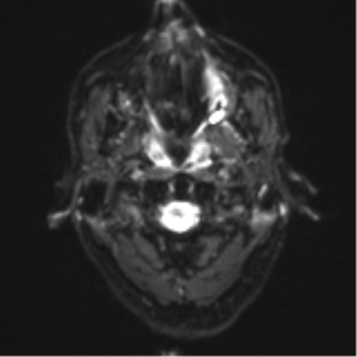 Cerebral metastasis - melanoma (Radiopaedia 54718-60954 Axial DWI 1).png