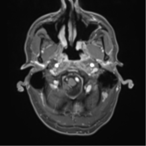 File:Cerebral metastasis - melanoma (Radiopaedia 54718-60954 Axial T1 C+ fat sat 7).png
