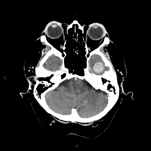 File:Cerebral metastasis from renal cell carcinoma (Radiopaedia 82306-96375 Axial C+ delayed 7).jpg