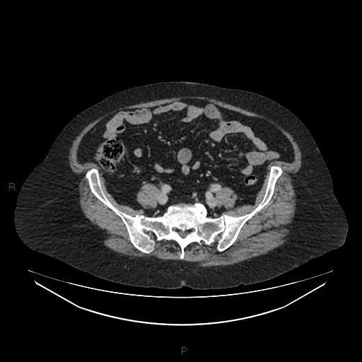 Cerebral metastasis from renal cell carcinoma (Radiopaedia 82306-96378 A 134).jpg