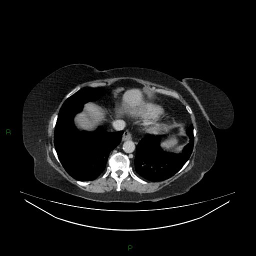 Cerebral metastasis from renal cell carcinoma (Radiopaedia 82306-96378 A 18).jpg