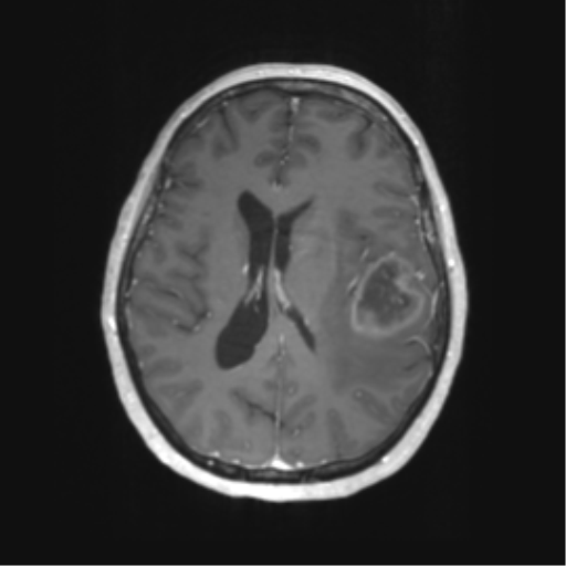 Cerebral metastasis mimicking glioblastoma (Radiopaedia 69155-78937 Axial T1 C+ 40).png
