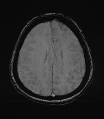 File:Cerebral metastasis to basal ganglia (Radiopaedia 81568-95413 Axial SWI 64).png