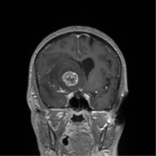 File:Cerebral metastasis to basal ganglia (Radiopaedia 81568-95413 Coronal T1 C+ 37).png