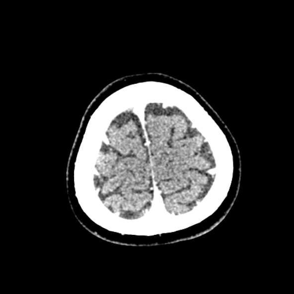 Cerebral ring enhancing lesions - cerebral metastases (Radiopaedia 44922-48818 B 257).jpg