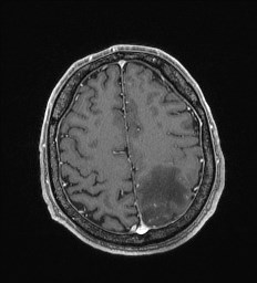 Cerebral toxoplasmosis (Radiopaedia 43956-47461 Axial T1 C+ 60).jpg