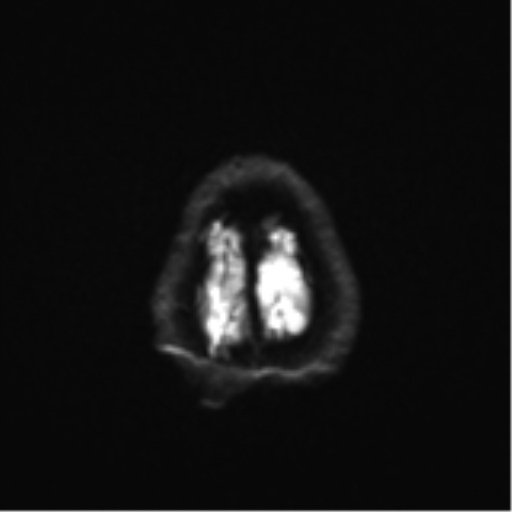 Cerebral toxoplasmosis (Radiopaedia 54575-60804 Axial DWI 30).png