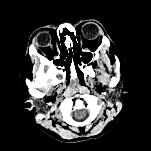 Cerebral tuberculosis with dural sinus invasion (Radiopaedia 60353-68018 Axial non-contrast 2).jpg