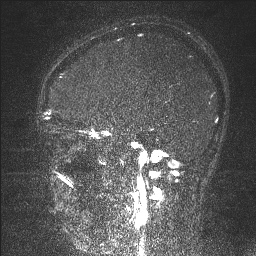Cerebral tuberculosis with dural sinus invasion (Radiopaedia 60353-68090 Sagittal MRV 103).jpg