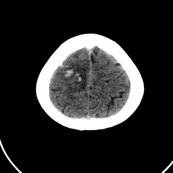 File:Cerebral venous hemorrhagic infarct from venous sinus thrombosis (Radiopaedia 55433-61879 Axial non-contrast 22).jpg