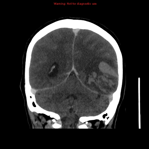Cerebral venous infarction (Radiopaedia 12404-20735 B 58).jpg