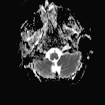 File:Cerebral venous infarction - hemorrhagic (Radiopaedia 81625-95505 Axial ADC 3).jpg