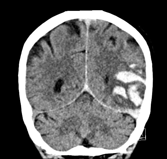 File:Cerebral venous infarction with hemorrhage (Radiopaedia 65343-74381 Coronal non-contrast 41).jpg