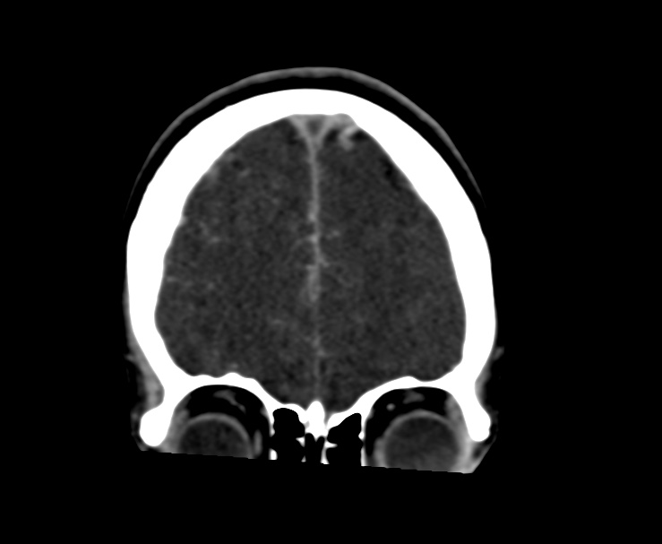 Cerebral venous sinus thrombosis (Radiopaedia 59224-66646 Coronal C+ delayed 11).jpg