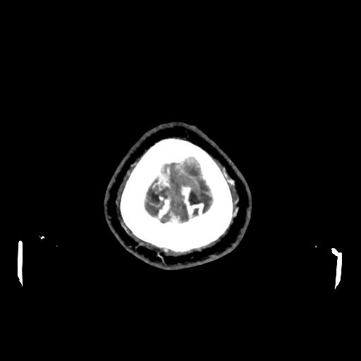 File:Cerebral venous throbmosis - hemorrhagic venous infarction (Radiopaedia 87318-103613 Axial CT venogram 40).jpg