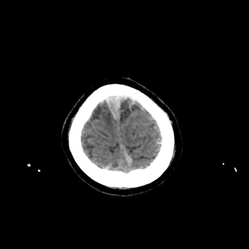 Cerebral venous throbmosis - hemorrhagic venous infarction (Radiopaedia 87318-103613 Axial non-contrast 161).jpg
