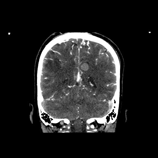 File:Cerebral venous throbmosis - hemorrhagic venous infarction (Radiopaedia 87318-103613 Coronal CT venogram 28).jpg