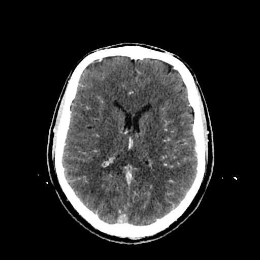 File:Cerebral venous thrombosis (CVT) (Radiopaedia 77524-89685 Axial with contrast 22).jpg