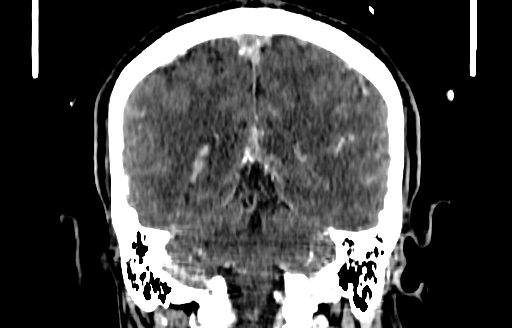 Cerebral venous thrombosis (CVT) (Radiopaedia 77524-89685 C 43).jpg