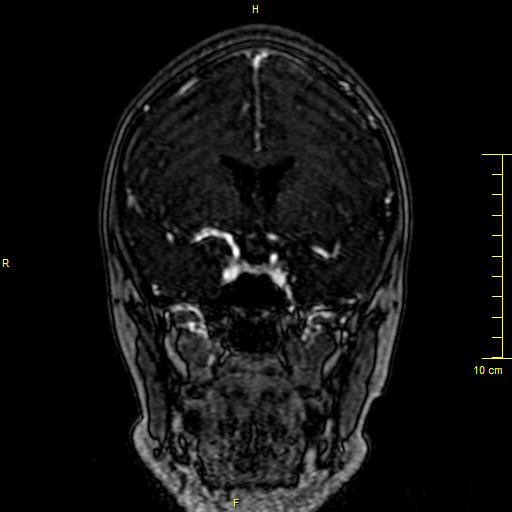 Cerebral venous thrombosis (Radiopaedia 23288-23351 MRV 50).JPG