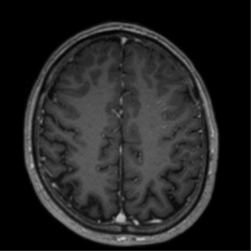 Cerebral venous thrombosis (Radiopaedia 38392-40469 Axial T1 C+ 58).png