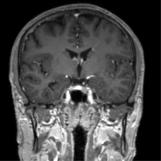 Cerebral venous thrombosis (Radiopaedia 38392-40469 Coronal T1 C+ 49).png