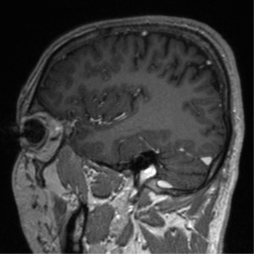 File:Cerebral venous thrombosis (Radiopaedia 38392-40469 Sagittal T1 C+ 65).png