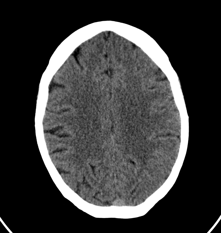 Cerebral venous thrombosis - CT only (Radiopaedia 41031-43778 Axial non-contrast 27).jpg