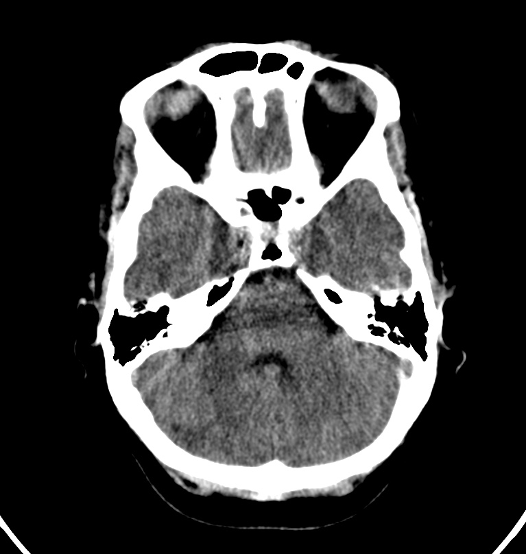 Cerebral venous thrombosis - CT only (Radiopaedia 41031-43778 Axial non-contrast 64).jpg