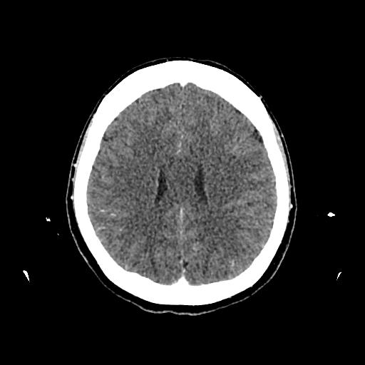 Cerebral venous thrombosis with venous hemorrhagic infarct (Radiopaedia 90354-107660 Axial with contrast 110).jpg