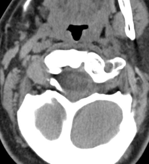 File:Cervical canal stenosis - OPLL and osteophytes (Radiopaedia 47329-51910 Axial non-contrast 14).png