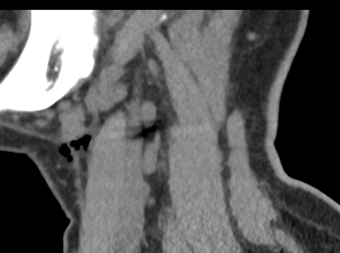 File:Cervical disc replacement (Radiopaedia 44025-47541 B 80).png